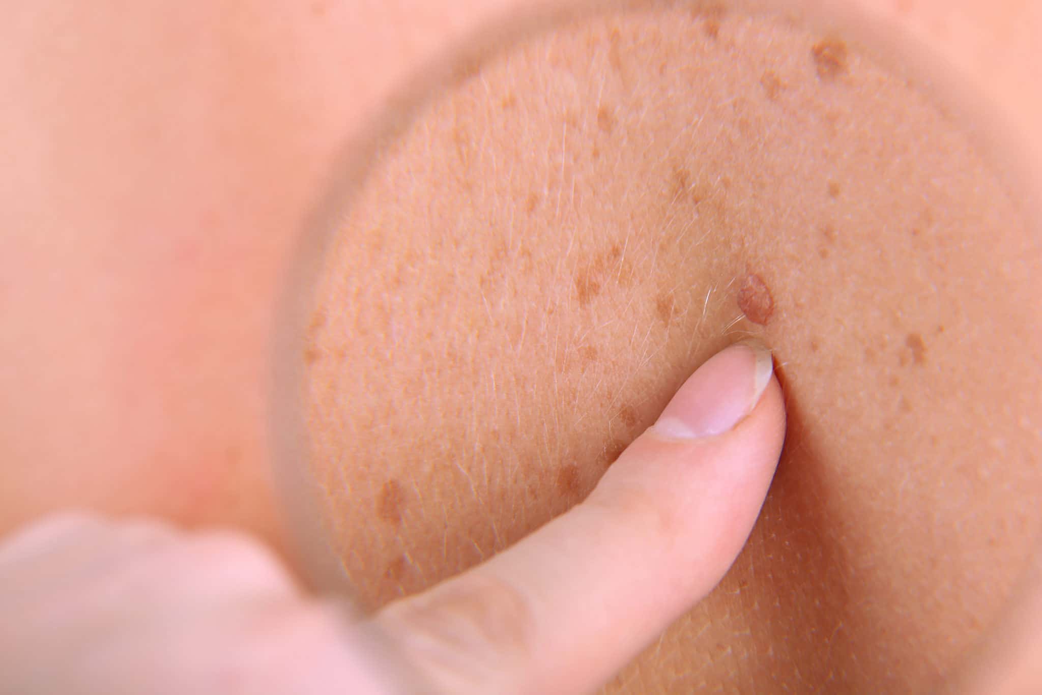 Dermatologist examines a birthmark of patient, close up